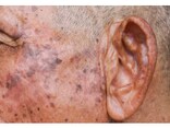 【症例画像】顔のイボ・老人性イボ「脂漏性角化症」の治療・予防法
