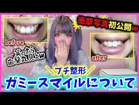 登録者70万人超えYouTuber・ちいめろ、口元整形のビフォアフ写真公開「どんどん可愛いくなっていって素敵」