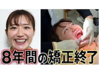 「有村架純になった」30万人超えYouTuber、歯列矯正のビフォーアフターに大反響！ 「やっぱり可愛い」