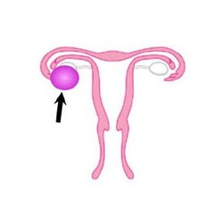 卵巣のう腫のイメージ