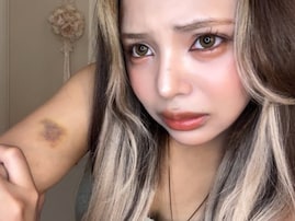 「怖すぎて家に帰るのが辛い」人気YouTuber、“ガチ”な心霊体験に驚きの声「こんなアザ初めてみた」