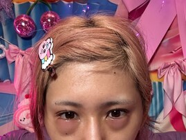 「突然目がこうなってしまって...」人気インフルエンサー、痛々しい姿に「朝イチで皮膚科受診」の声