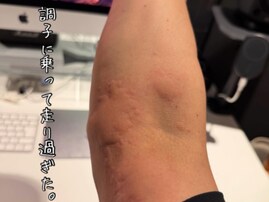 「やだなんで、、」樽美酒研二、水ぶくれに心配の声。「うわー、大丈夫ですか？」「本当に心配です」