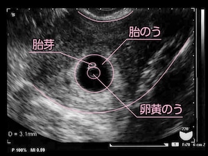 妊娠6週目 エコー写真・胎芽や胎嚢大きさ・心拍確認や気になる流産 ...