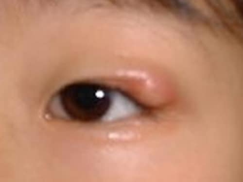 瞼が腫れる原因
