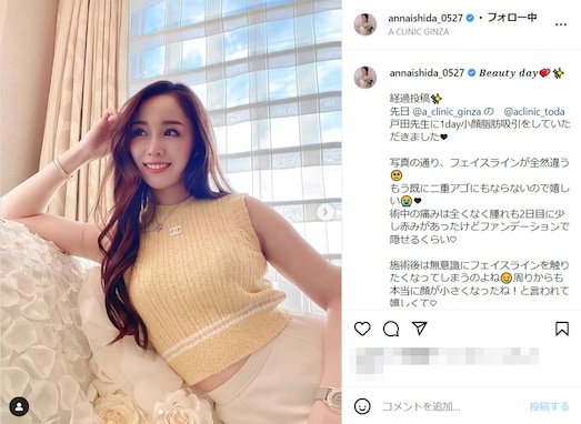 元SKE48・石田安奈、脂肪吸引後のフェイスラインを公開！ 「天使すぎ」「より一層可愛いです」