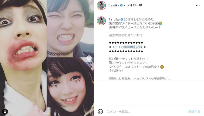 ファーストサマーウイカ、歯列矯正ビフォーアフター披露！ 「すごく綺麗になったね」「めちゃくちゃ可愛いなぁ」