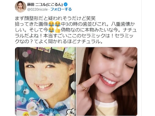 「整形だと疑われそう」藤田ニコル、中3当時との歯並び比較画像公開に「全然わからなかった」と驚きの声