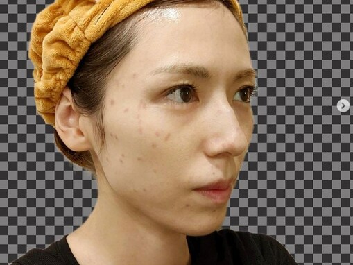 若槻千夏、シミ取りレーザー後のすっぴん披露！ 「シミあっても可愛い人を初めて見た…」「素が可愛すぎて」