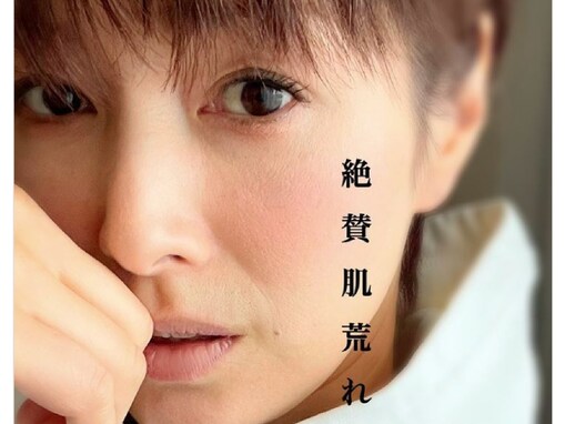 吉瀬美智子、“肌荒れ中”の写真を公開しファン困惑 「肌荒れしてても綺麗…」「荒れ方が普通と違いますね」