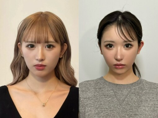 「骨切り無しでこれエグい」23歳ギャルモデル、小顔矯正で激変した姿に反響！ 「すごすぎます」