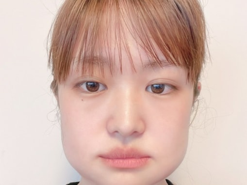 元乃木坂46・伊藤かりん、顎変形症手術1年後のショットを公開！ 「絵文字になれるぐらいかわいい」