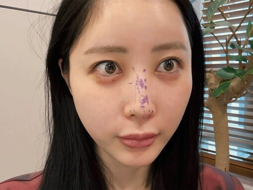 「垢抜けすぎ」登録者180万人超えYouTuber、鼻整形を報告。ダウンタイムの様子を公開し「大成功」の声