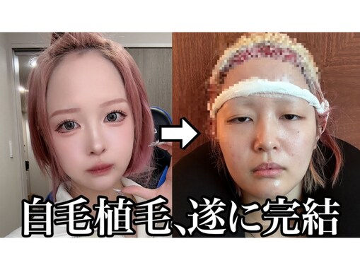 「大成功すぎて毎日幸せ」登録者数100万人超えYouTuber、“広すぎるデコ”の整形を告白「天使すぎ」