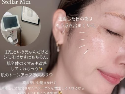 「肌にハリが出た」木下優樹菜、シミ取りした肌を公開！ 「投稿見ると励まされます」「経過楽しみ」