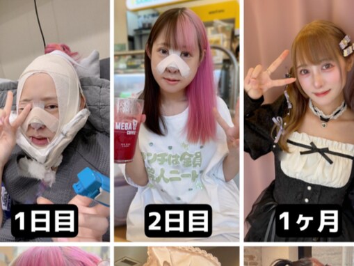 「輪郭と鼻の骨切りをしてから10ヶ月」人気歌い手、整形後の経過を公開！ 「綺麗」「絶え間ない努力」