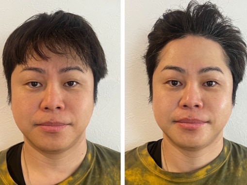 「別人級ですね」人気お笑い芸人、美容施術でイケメンに？ 比較ショット公開「いい顔」「目もパッチリ」