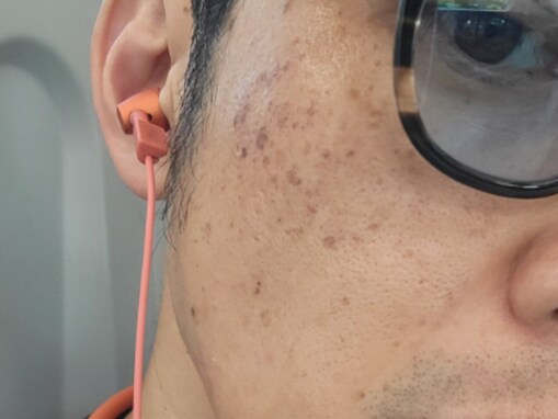 「イケオジになる」キンコン西野、シミ取りレーザー施術を報告！ 「もう十分イケおじなのに」の声も