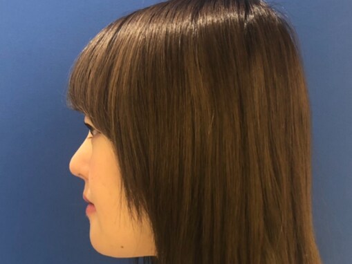 「1,350万円も安いもんよ」整形アイドル、劇的ビフォーアフターを披露！ 「ほんとに若返ってる」