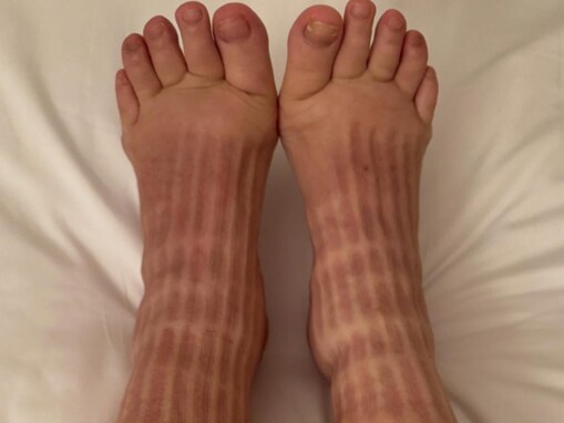 「赤ちゃんの足だと思いました！」双子出産の中川翔子、“むくみとのたたかい”を公開。「伊達巻みたい」