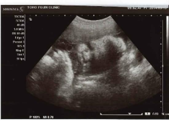 画像 妊娠34週 胎児の大きさや体重をエコー写真で確認 逆子は治る 妊娠後期 All About