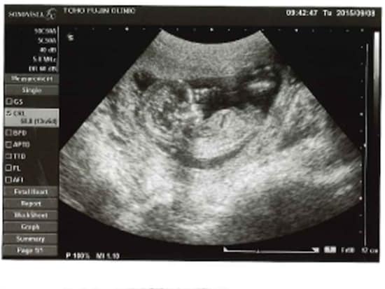 妊娠13週目エコー写真と胎児の大きさ 性別や胎動はいつわかる 妊娠初期 All About