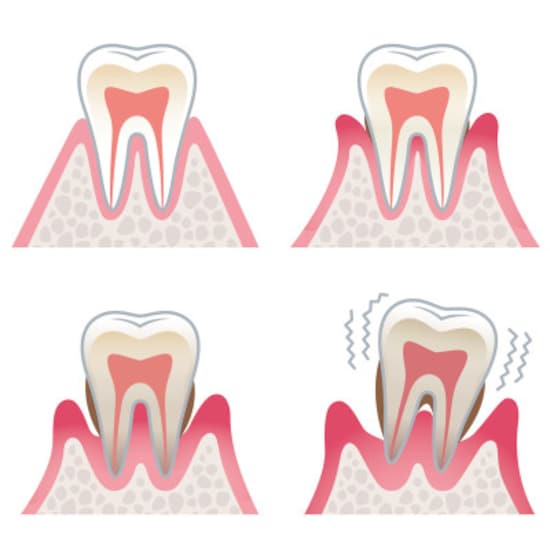 歯周病では骨が溶け、歯が抜けてしまう