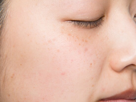 ビフォア。色ムラや毛穴が気になります。