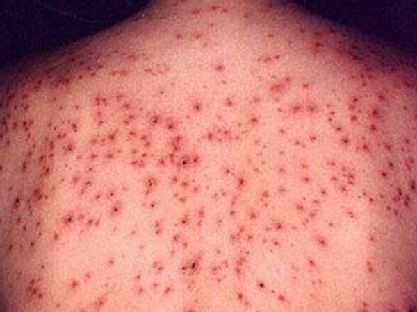 主な皮膚の病気一覧 症例画像 症状 原因 治療法 医師が解説 皮膚 爪 髪の病気 All About