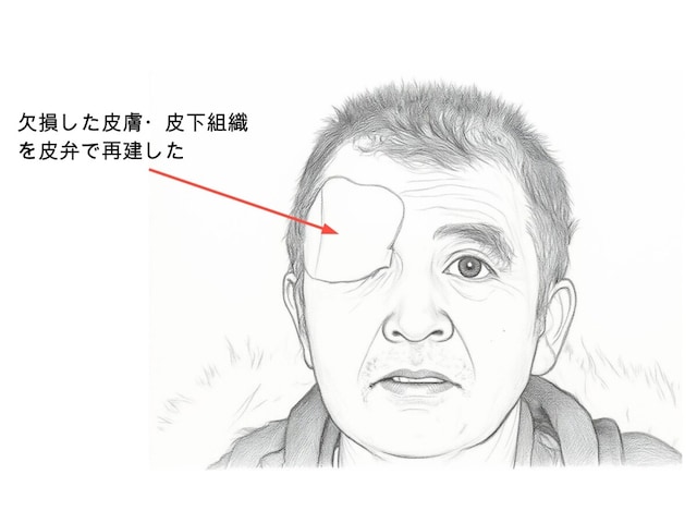 クマ外傷　皮膚欠損　再建