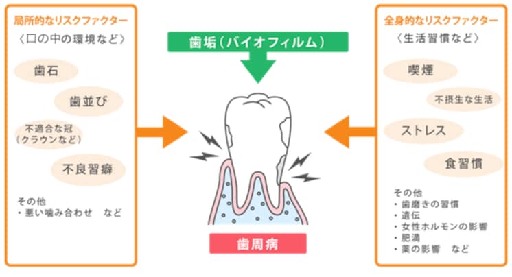歯 周 病 の リスク ファクター