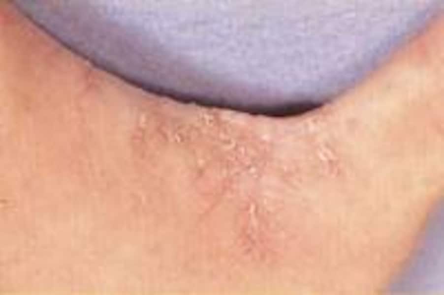 アトピー性皮膚炎に似た病気 [アトピー性皮膚炎] All About