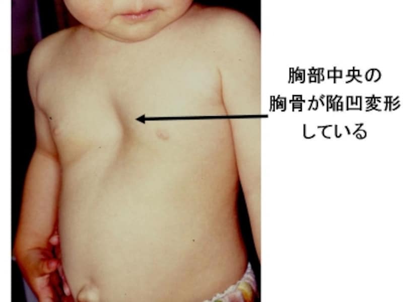 漏斗胸の診断・治療 [骨・筋肉・関節の病気] All About