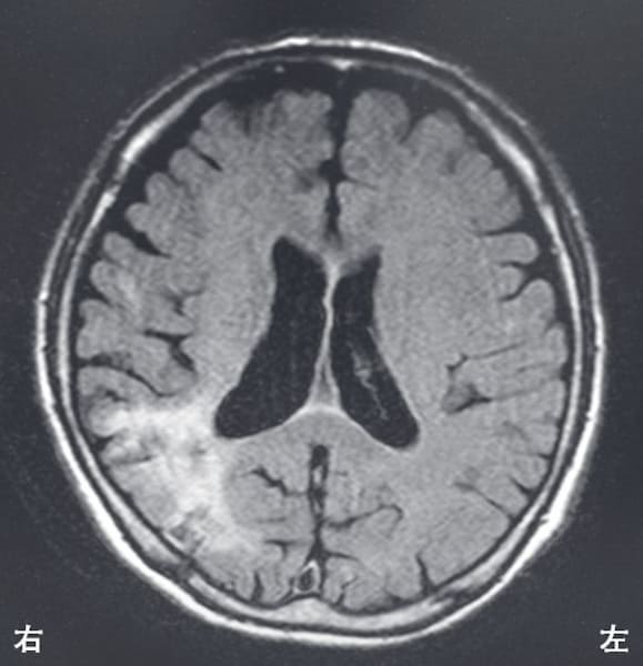 JLC ** 脳血管障害に対する理学療法 理学療法士（PT）国試 脳血管障害の問題傾向 [理学療法士] All About