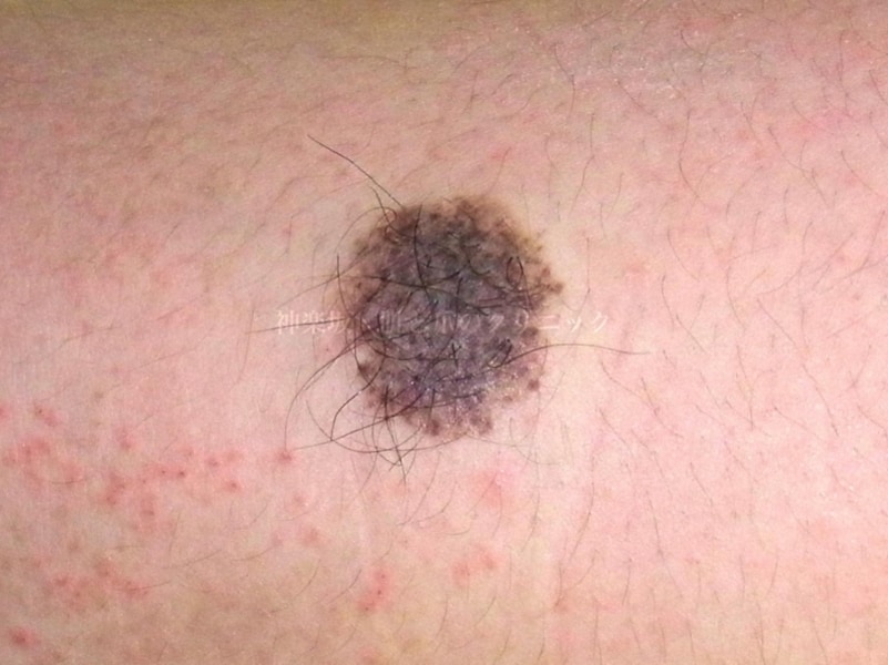 症例写真】粉瘤・母斑・脂肪腫・硬いおできなど皮膚のできもの [皮膚・爪・髪の病気] All About