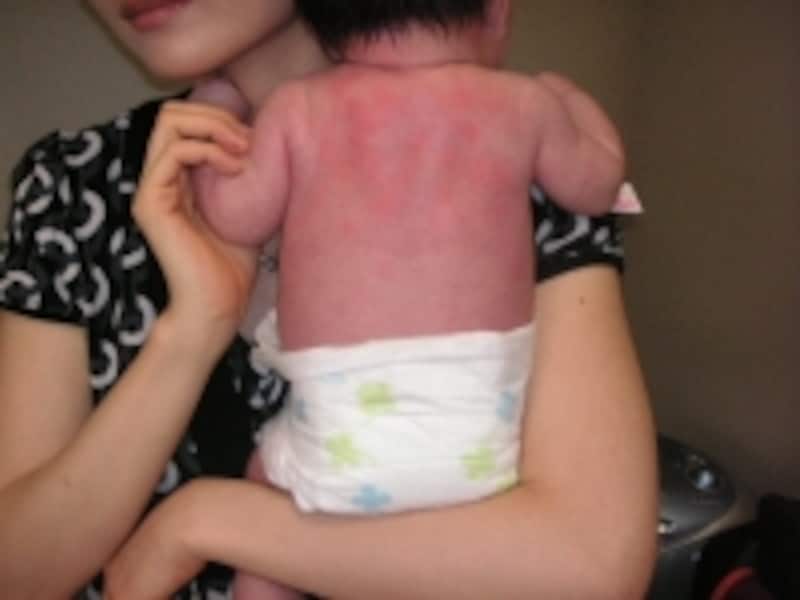 赤ちゃんの背中に出来た汗疹です