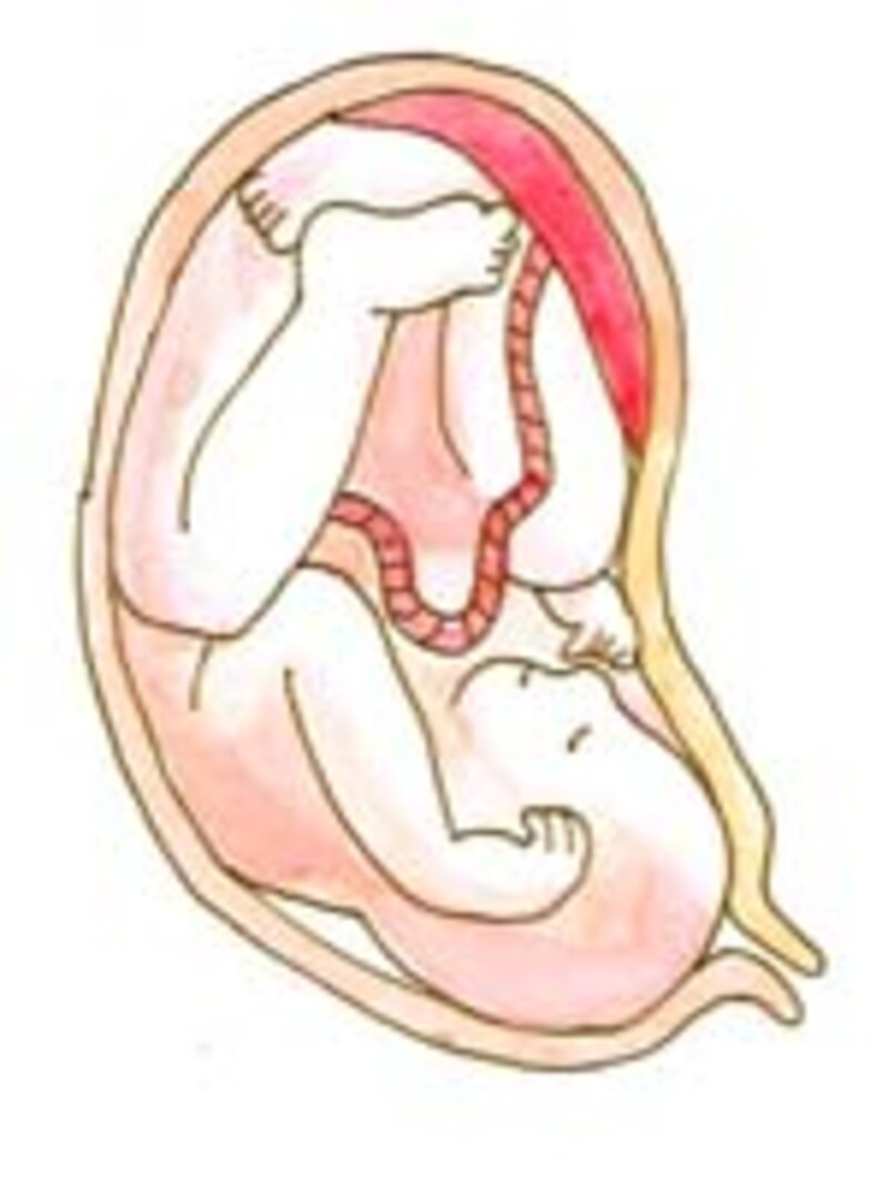 紀子様はなぜ帝王切開になるの 妊娠の基礎知識 all about