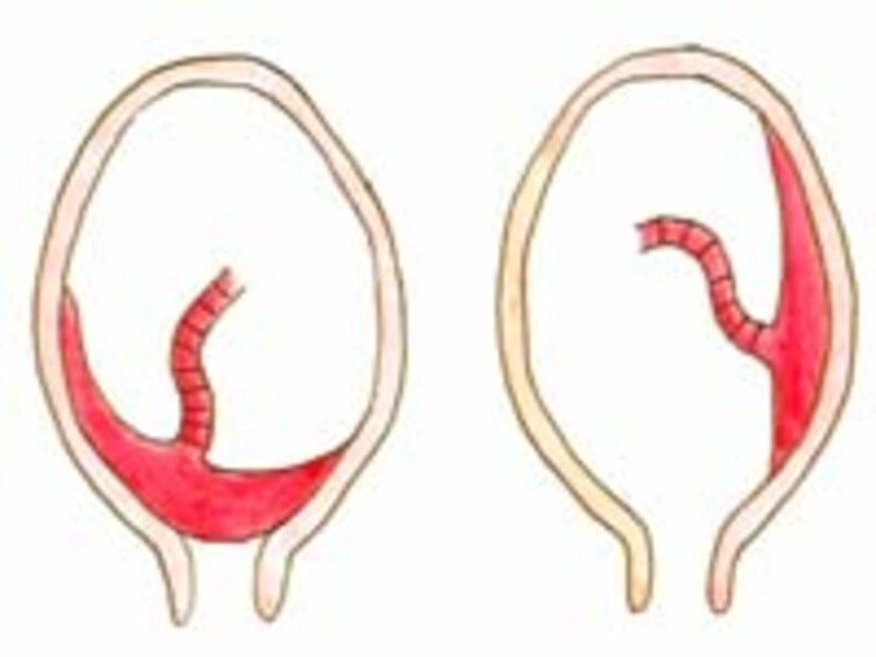 紀子様はなぜ帝王切開になるの 妊娠の基礎知識 all about