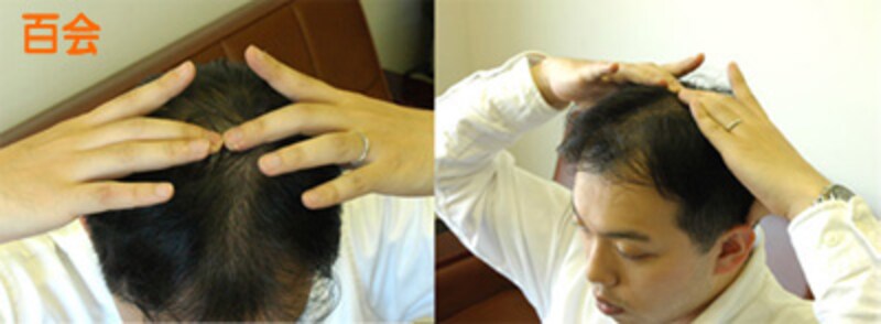 百会（ひゃくえ）