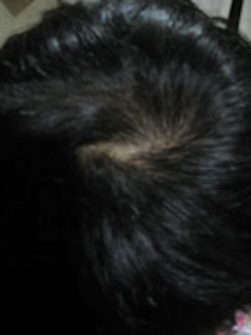 自己診断薄毛チェック術 気になる人必見 男のヘアケア All About 自己診断薄毛チェック術 気になる人必見 男のヘアケア All About
