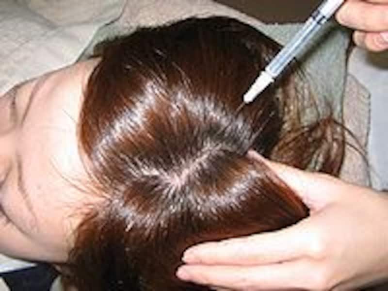 頭皮メソセラピー