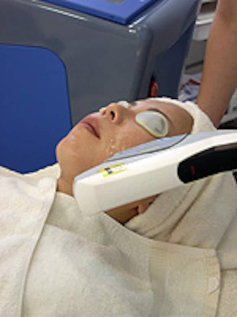 スーパーフォトフェイシャル