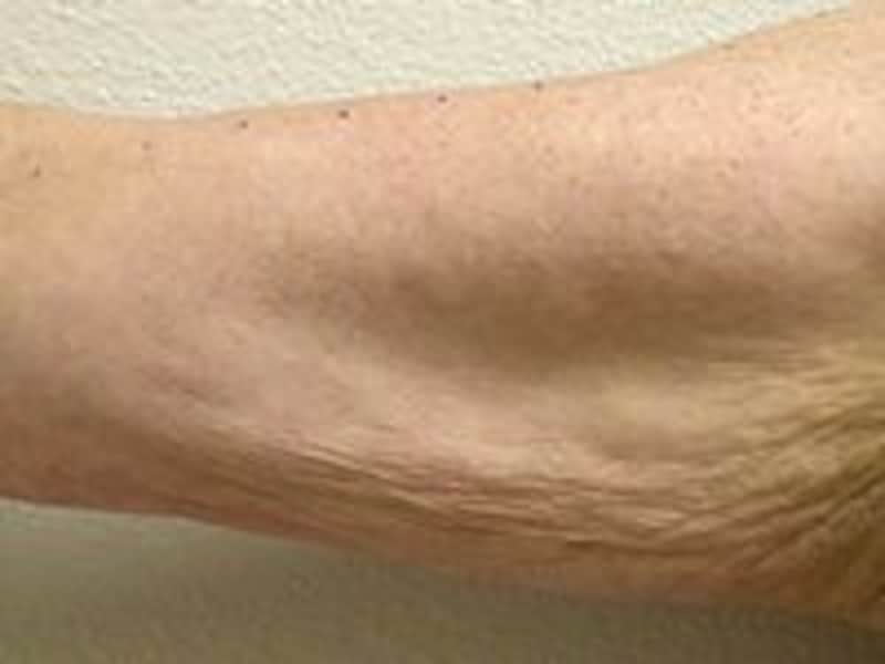 サーマクールビフォア