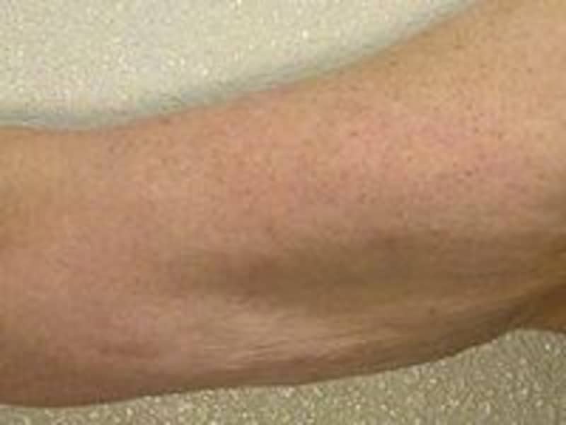 サーマアフター