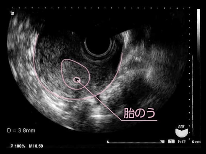 妊娠2か月の胎児の様子や妊婦の症状・妊娠生活注意点