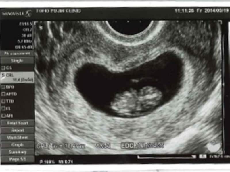 妊娠8週（妊娠3ヶ月,三ヶ月,3カ月）エコー写真・超音波写真