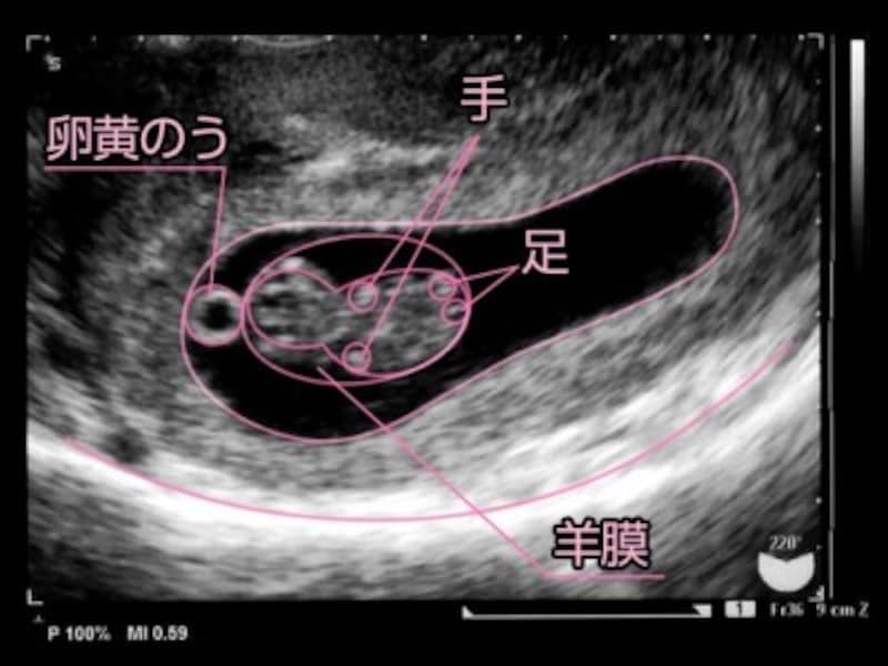 妊娠9週（3ヶ月,三ヶ月,3カ月）エコー写真・超音波写真