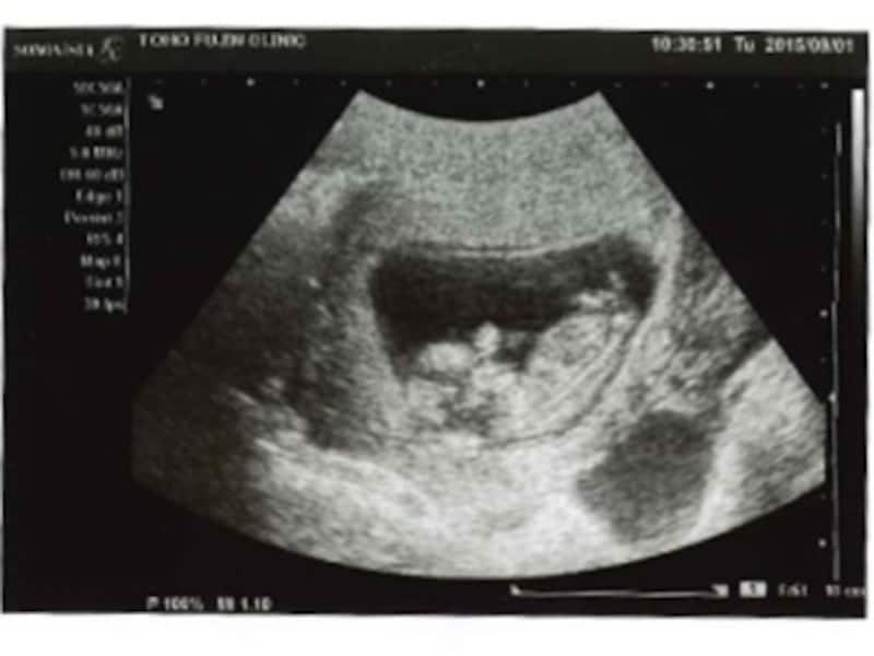 妊娠12週（妊娠4ヶ月,四ヶ月,4カ月）エコー写真・超音波写真