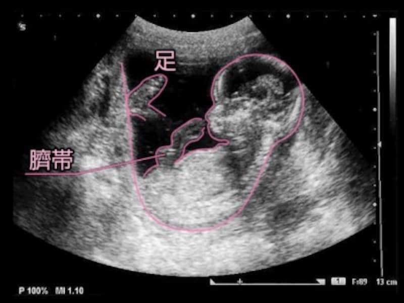 妊娠14週（妊娠4ヶ月,四ヶ月,4カ月）エコー写真・超音波写真