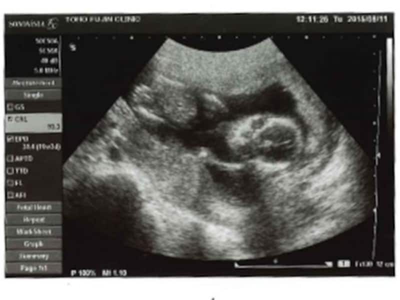 妊娠16週（妊娠5ヶ月,五ヶ月,5カ月）エコー写真・超音波写真